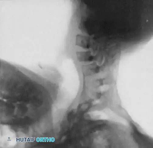 UNUSUAL CAUSES OF KYPHOSIS Surgical Diagram