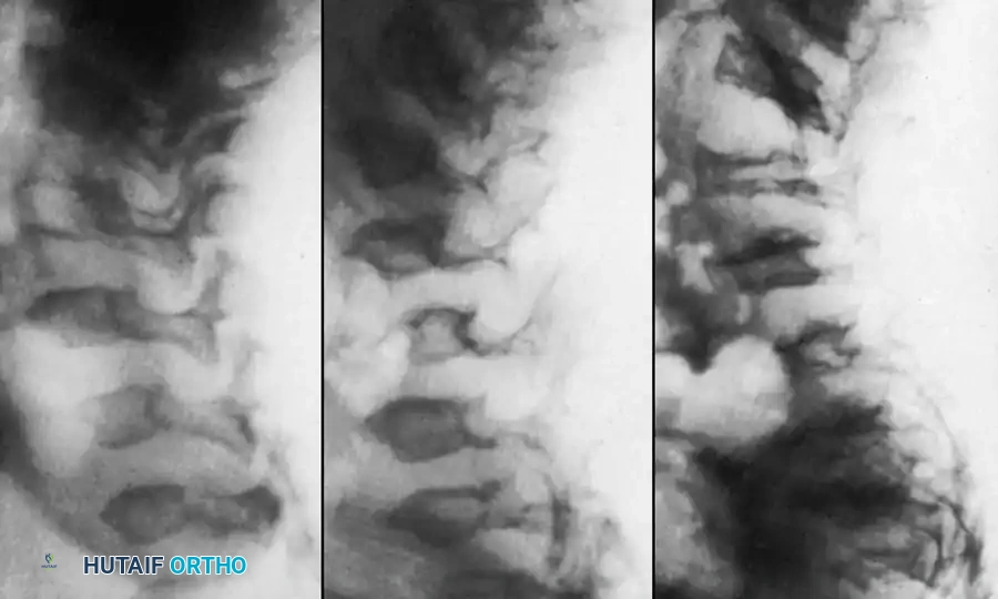 UNUSUAL CAUSES OF KYPHOSIS Surgical Diagram