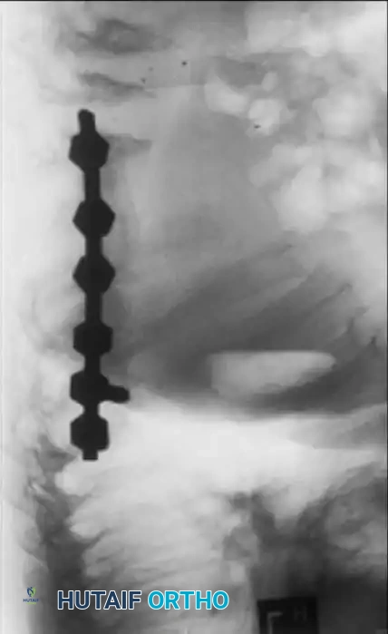 UNUSUAL CAUSES OF KYPHOSIS Surgical Diagram