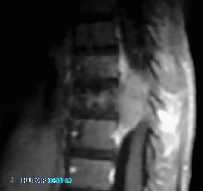 Surgical Management of Spinal Deformities in Neurofibromatosis