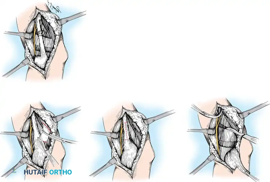 UPPER EXTREMITY Surgical Diagram