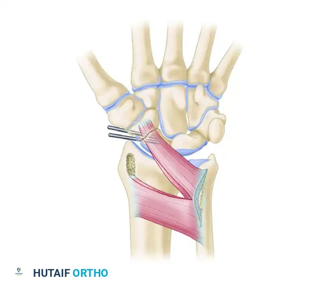 Vascularized Bone Grafts for Scaphoid Nonunion