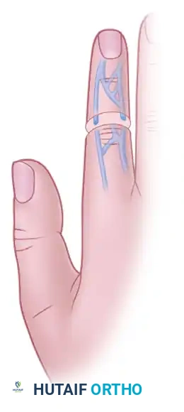 Vessel Repair in Replantation: Advanced Microsurgical Techniques