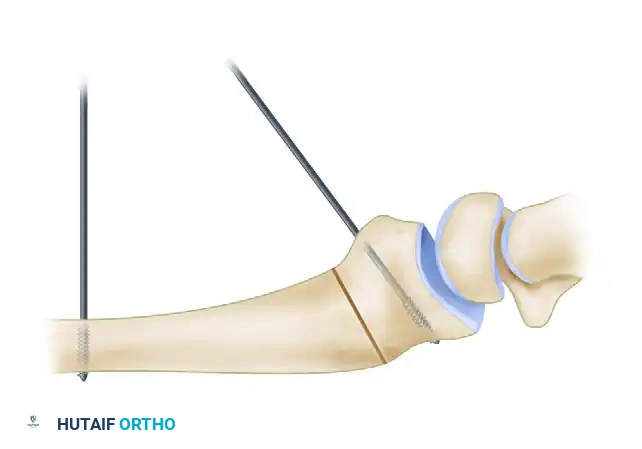 Volar Osteotomy for Distal Radius Malunion: A Comprehensive Surgical Guide