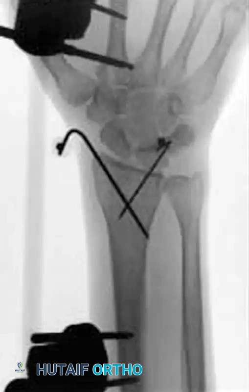 Crossed-pin augmentation radiograph 1