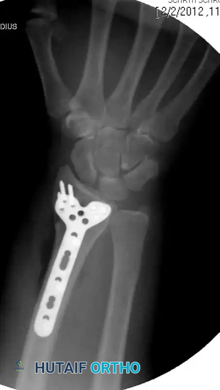 Volar Plate Fixation Oblique Radiograph