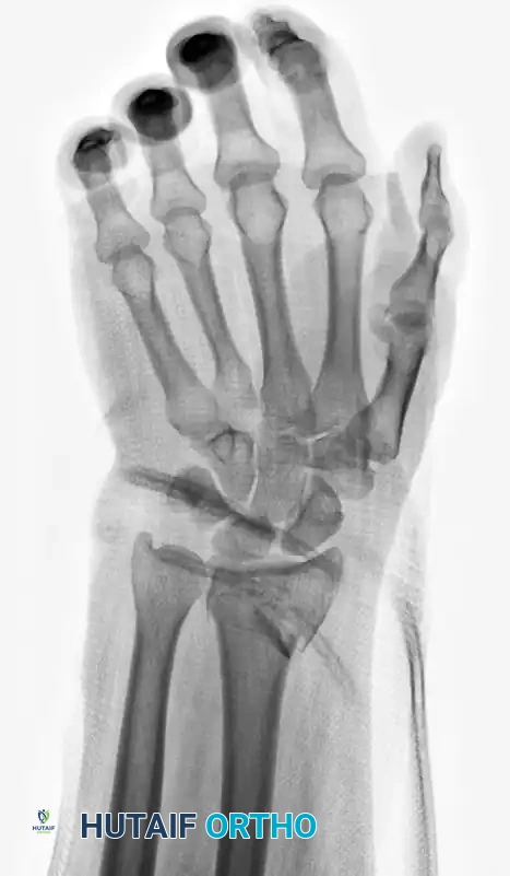 Volar Plate Fixation AP Radiograph