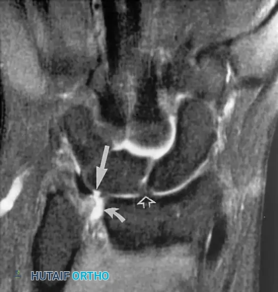 Fig. 2-33 Triangular ﬁbrocartilage perforation. Coronal fatsuppressed, proton density–weighted image of wrist shows central perforation of triangular ﬁbrocartilage (long arrow). Note ﬂuid in distal radioulnar joint (curved arrow). Scapholunate ligament (open arrow) is intact in this wrist.