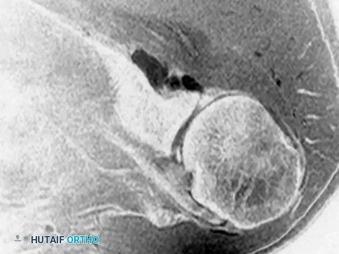 Fig. 2-32 Soft-tissue ganglion in painful shoulder. Oblique coronal fat-suppressed, proton density–weighted image of left shoulder reveals homogeneous hyperintense lesion in spinoglenoid notch. Ganglia and other masses in this location can be associated with suprascapular nerve entrapment. Note subtle hyperintensity indicating edema in infraspinatus muscle along posterior scapula related to denervation (arrow).