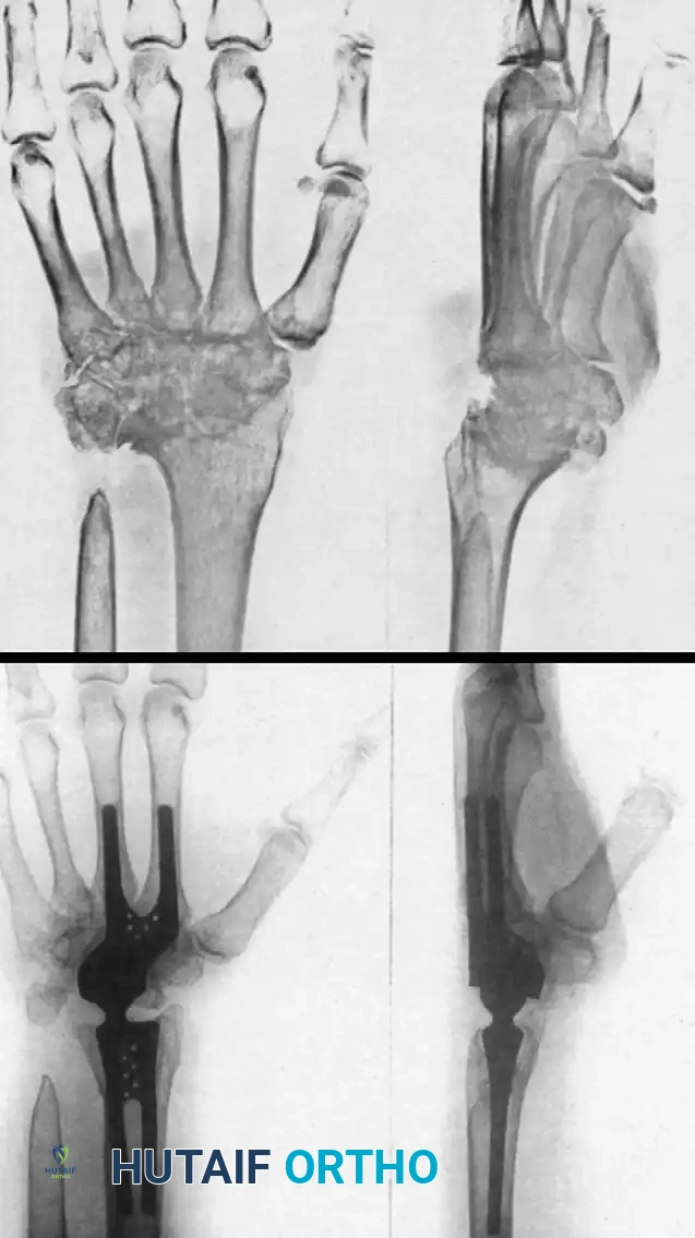 Wrist Arthrodesis and Arthroplasty: Advanced Surgical Techniques