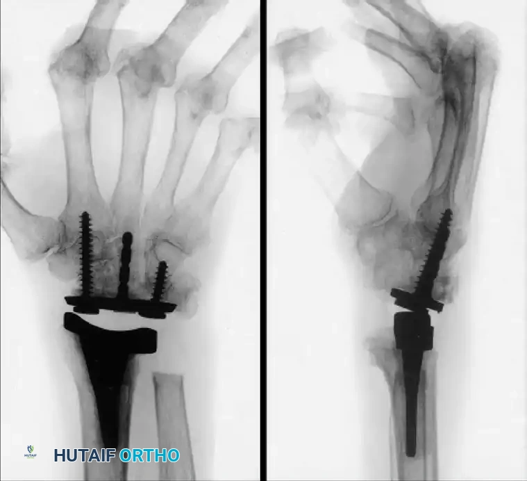 WRIST ARTHRODESIS AND ARTHROPLASTY Surgical Diagram