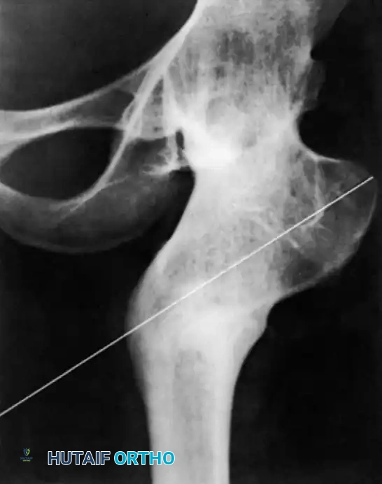 صورة شعاعية بعد الجراحة تظهر قطع عظم الفخذ الداني بزاوية عالية