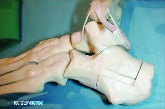 Z -SHAPED CALCANEAL OSTEOTOMY Surgical Diagram