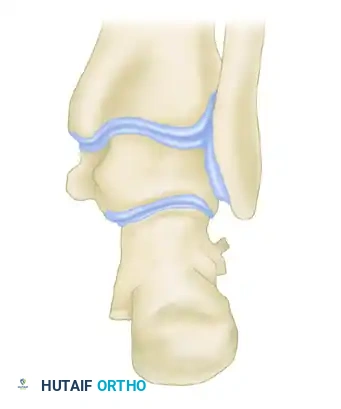 Z -SHAPED CALCANEAL OSTEOTOMY Surgical Diagram