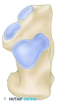 Z -SHAPED CALCANEAL OSTEOTOMY Surgical Diagram