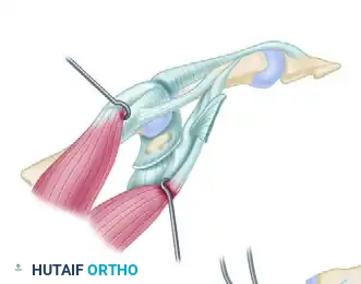 Zancolli Reconstruction for Tetraplegia: Surgical Guide