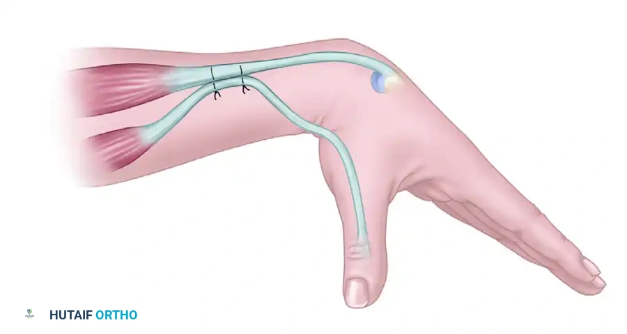 ECRB to FPL Side-to-Side Transfer