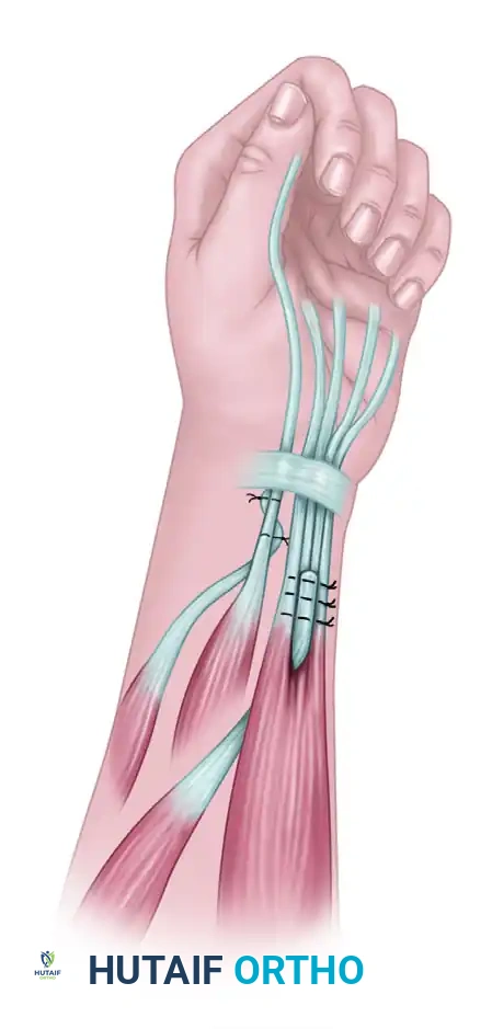 ECRB to FPL Tensioning Detail