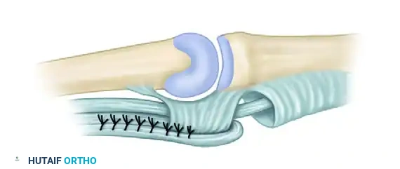 Zancolli Lasso Suturing Detail