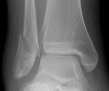 Syndesmosis TightRope / Suture Button