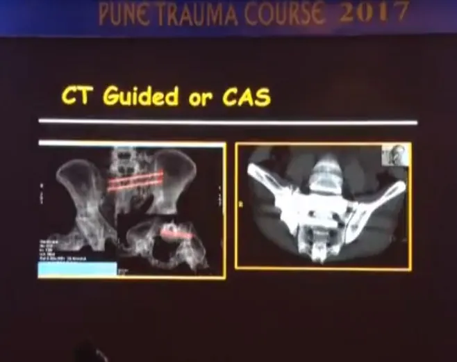 Sacroiliac (SI) Joint Fixation Screws