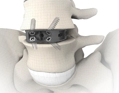 ALIF Interbody Cage (Anterior Lumbar)