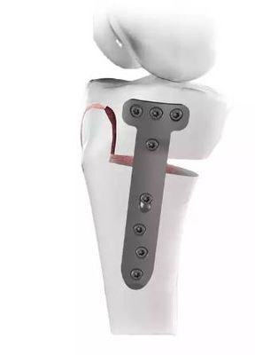 High Tibial Osteotomy (HTO) Plate (TomoFix)