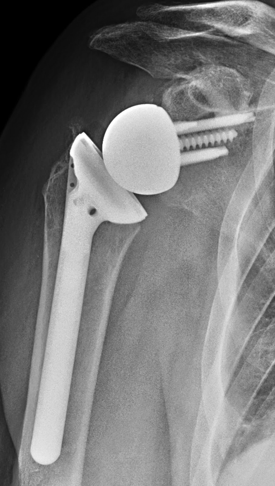 Reverse Total Shoulder Prosthesis