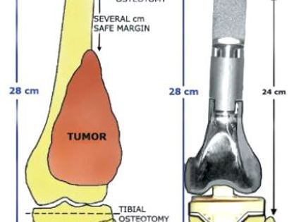 Distal Femoral Replacement (Tumor Prosthesis)