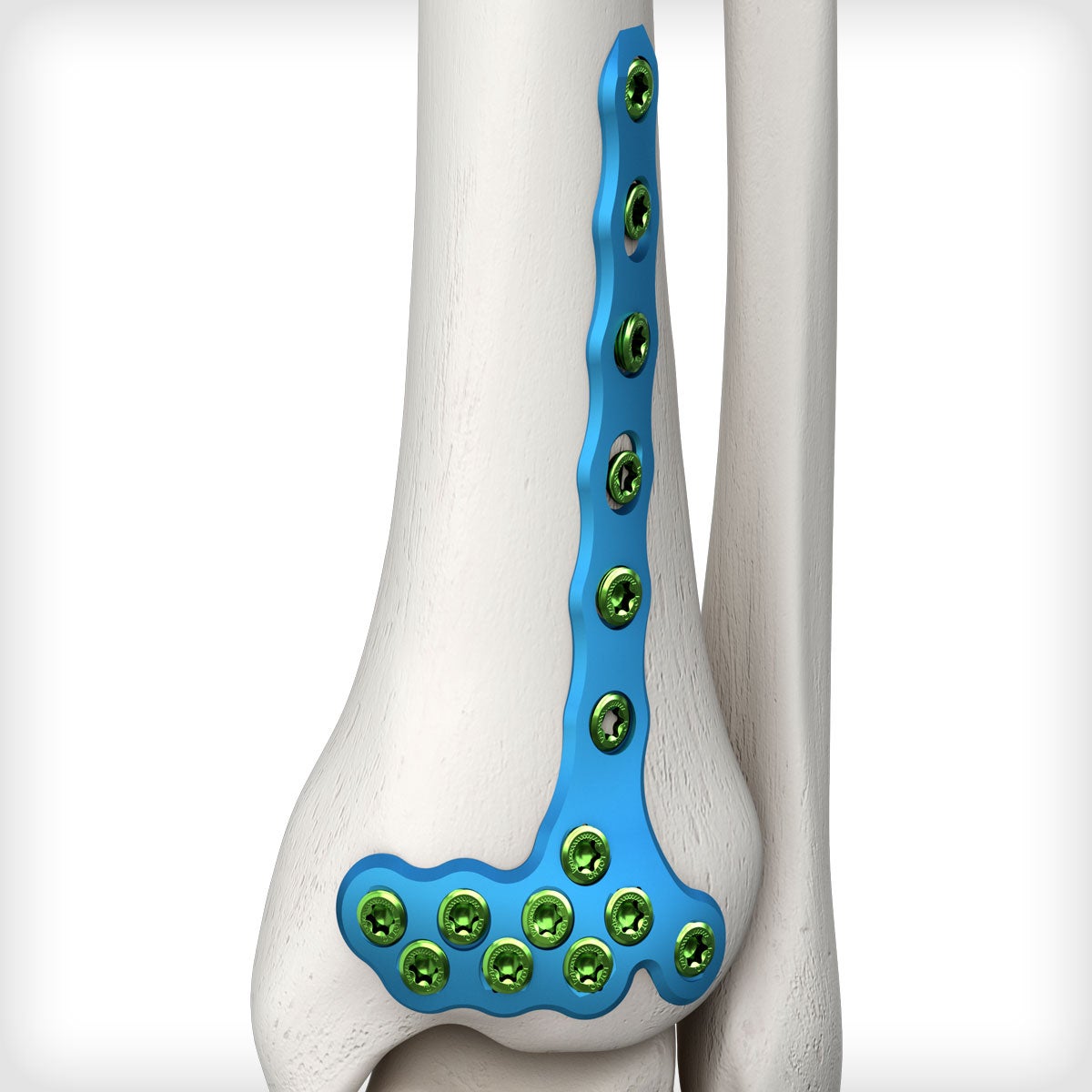 Anterolateral Distal Tibia (Pilon) Plate