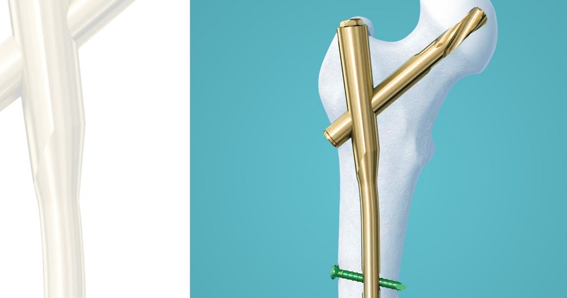 Proximal Femoral Nail Antirotation (PFNA)
