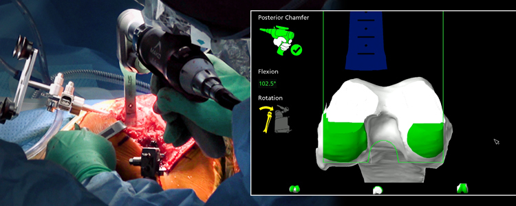 Robotic-Arm Assisted Arthroplasty System (e.g., Mako)