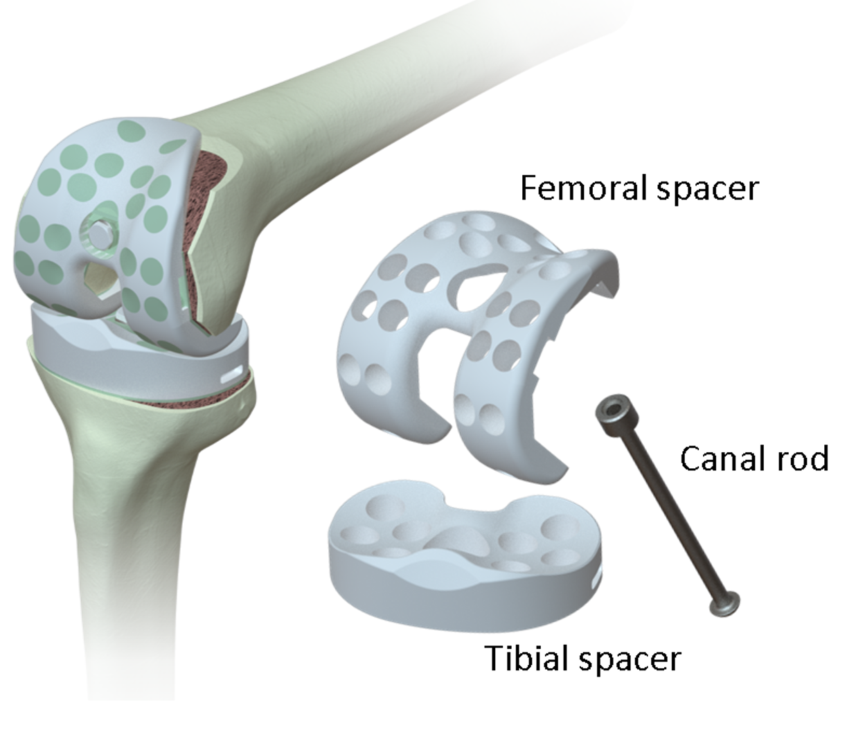 Pre-Formed Articulating Antibiotic Spacer