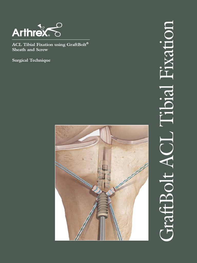 Tibial Inlay Graft Fixation (ACL)