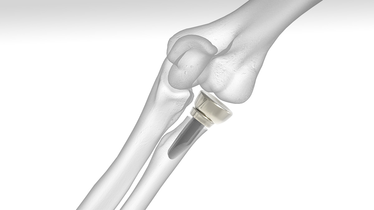 Radial Head Prosthesis (Modular, Monoblock)