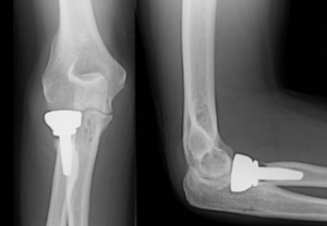 Radial Head Resection Arthroplasty Spacer