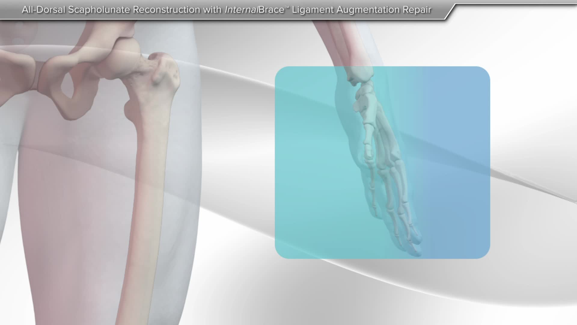 Scapholunate Reconstruction Screw (Dorsal)