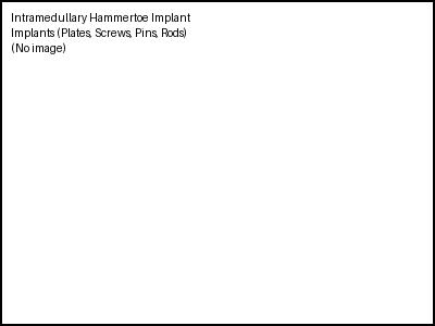 Intramedullary Hammertoe Implant