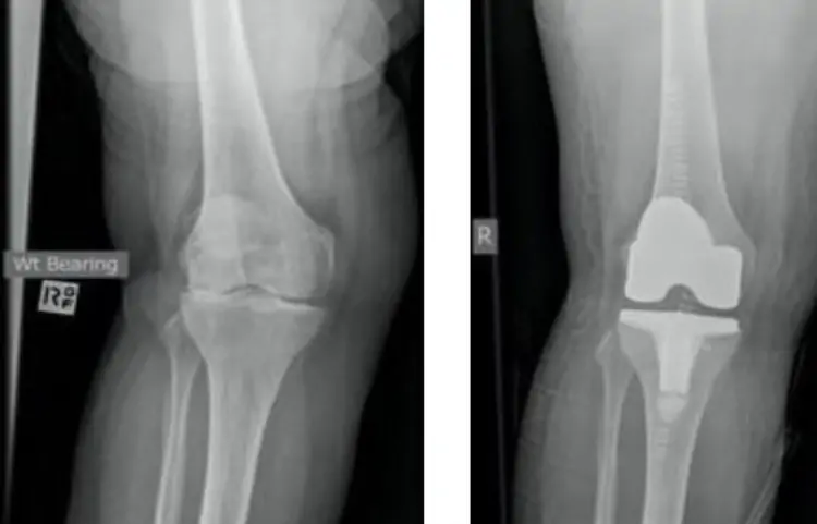 صورة أشعة ركبة عادل