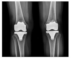 صورة أشعة ركبة علي