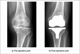 صورة أشعة ركبة هنادي بعد الجراحة