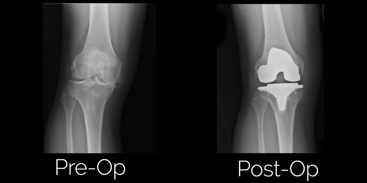صورة أشعة ركبة خالد