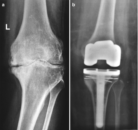 صورة أشعة ركبة الفنانة منى
