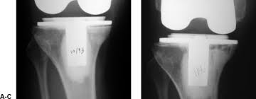 صورة أشعة ركبة سلوى