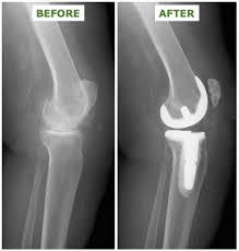 صورة أشعة ركبة سامي