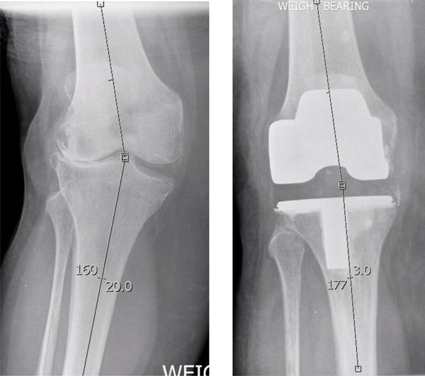 صورة أشعة ركبة الأميرة سارة