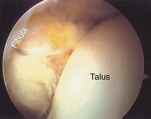 Orthopedic MCQs (Set 1): Humeral Fractures & Compartment Syndrome | AAOS ABOS Review