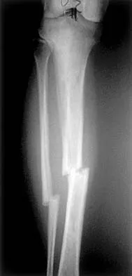 AAOS & ABOS Basic Science MCQs (Set 3): Orthopedic Biomechanics & Bone Physiology | OITE Review