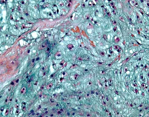 Basic Science Board Review 2005: High-Yield MCQs (Set 2) - Figure 14