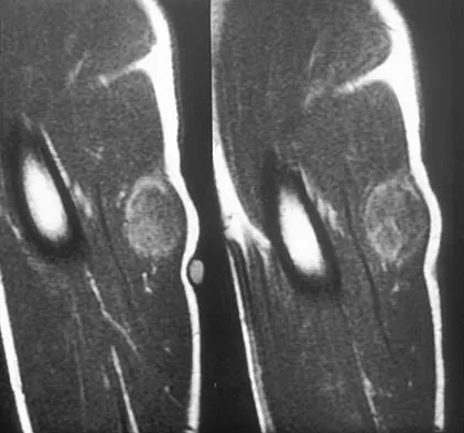 Orthopedic 2026 MCQs (Set 1): Humeral Fractures, Compartment Syndrome & Stress Fractures | ABOS, AAOS Board Review